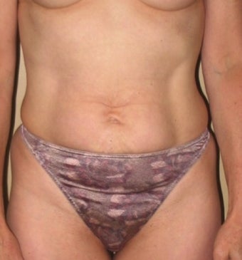 Tummy Tuck before 1219918