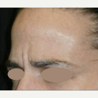35-44 year old woman treated with Botox before 3163174