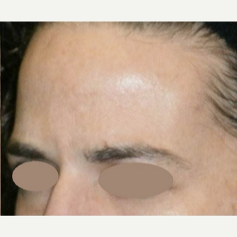 35-44 year old woman treated with Botox after 3163174