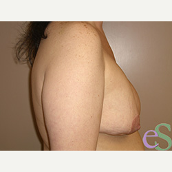 Breast Implant Revision before 3373374