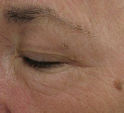 Crows feet and eye wrinkles treated with 1 treatment of Lux 1540 Fractional Laser after 52903