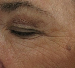 Crows feet and eye wrinkles treated with 1 treatment of Lux 1540 Fractional Laser before 52903