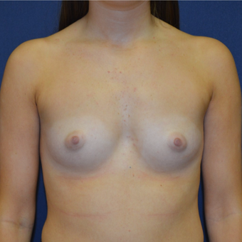 18-24 year old woman treated with Breast Augmentation before 3092326