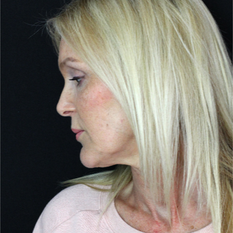 45-54 year old woman treated with Lower Face Lift before 2877982