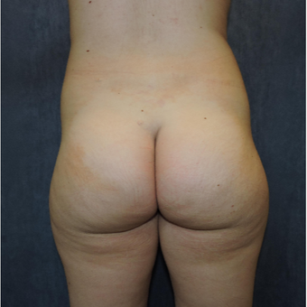 18-24 year old woman treated with Brazilian Butt Lift before 3685135