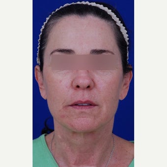 45-54 year old woman treated with Neck Lift 1984640