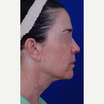 45-54 year old woman treated with Neck Lift before 1984640