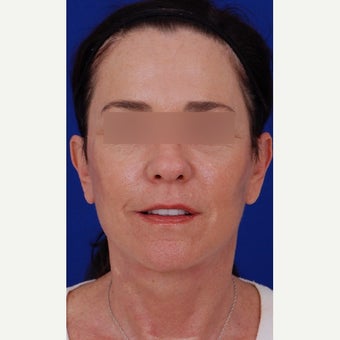 45-54 year old woman treated with Neck Lift 1984640