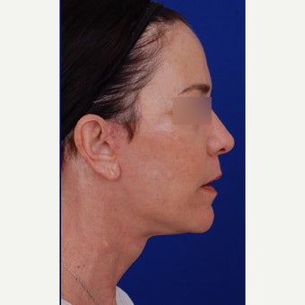 45-54 year old woman treated with Neck Lift after 1984640