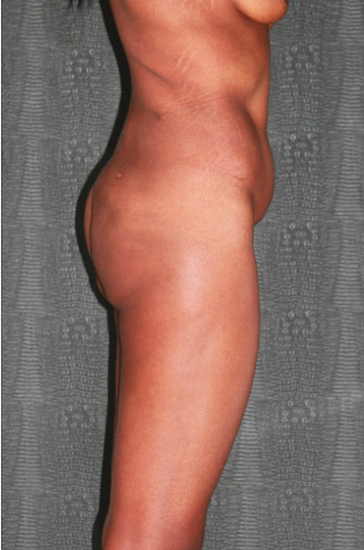 25-34 year old woman with complications for liquid Silicone Injections (Biopolimeros) 1831080
