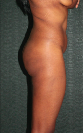 25-34 year old woman with complications for liquid Silicone Injections (Biopolimeros) 1831080
