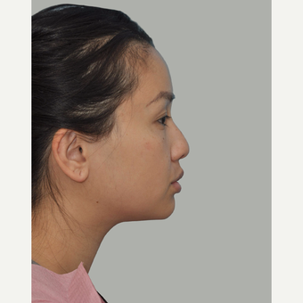 25-34 year old woman treated with Asian Rhinoplasty before 3524660