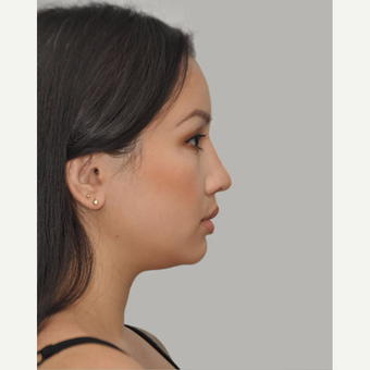 25-34 year old woman treated with Asian Rhinoplasty after 3524660