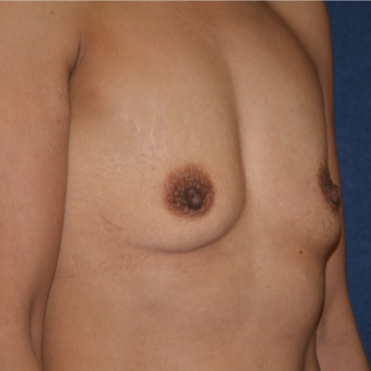 45-54 year old woman treated with Ideal Implant before 3413170