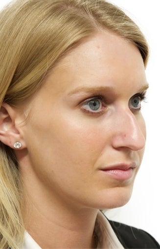 25-34 year old woman treated with Rhinoplasty 3066664