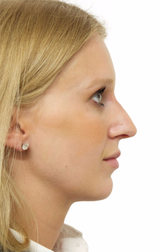 25-34 year old woman treated with Rhinoplasty after 3066664