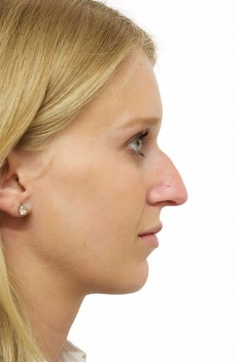 25-34 year old woman treated with Rhinoplasty before 3066664