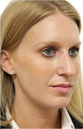 25-34 year old woman treated with Rhinoplasty 3066664