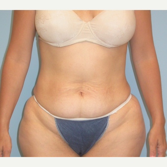 41 year old with tummy tuck before 3142090
