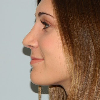 35-44 year old woman treated with Rhinoplasty after 3506077