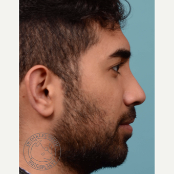 25-34 year old man treated with Rhinoplasty after 3092628