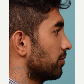 25-34 year old man treated with Rhinoplasty before 3092628