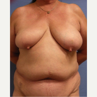 55-64 year old woman treated with Breast Reconstruction before 3644497
