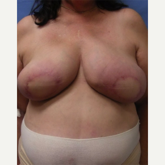 55-64 year old woman treated with Breast Reconstruction after 3644497