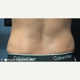 "Love Handles" Reduced with Kybella before 3575285