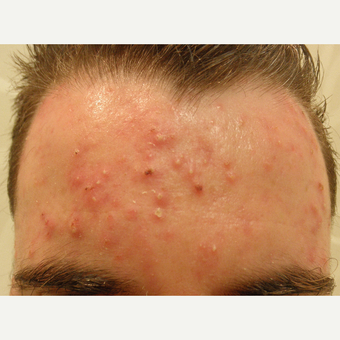 Acne can be treated with many methods. before 3710536