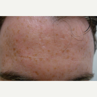 Acne can be treated with many methods. after 3710536