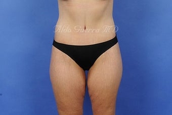 35 Year Old Female Extended Tummy Tuck After Major Weight Loss after 975129