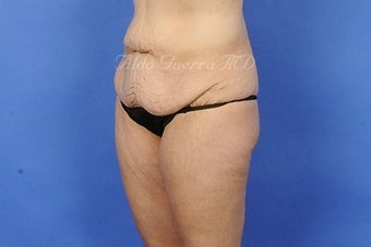 35 Year Old Female Extended Tummy Tuck After Major Weight Loss 975129