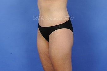 35 Year Old Female Extended Tummy Tuck After Major Weight Loss 975129