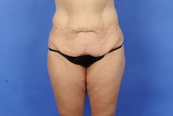 35 Year Old Female Extended Tummy Tuck After Major Weight Loss before 975129
