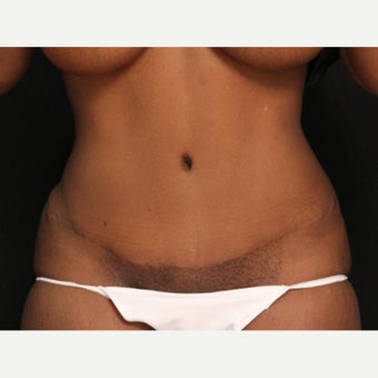 African-American Female Minimal Scar Abdominoplasty after 1665226
