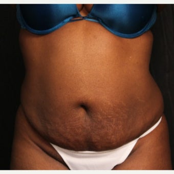 African-American Female Minimal Scar Abdominoplasty before 1665226