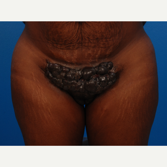 35-44 year old woman with severe keloids treated with Cryoshape procedure and post-op Kenalog inj before 2497853