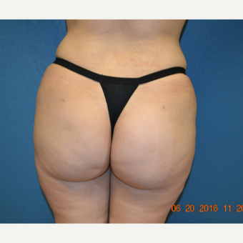 35-44 year old woman treated with Brazilian Butt Lift after 3170020