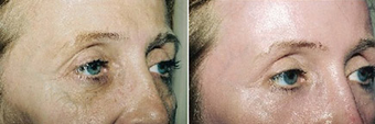 Chemical Peel before 1431798