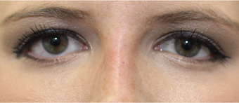 nose filler to narrow and raise height of upper nasal dorsum after 3166888