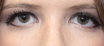 nose filler to narrow and raise height of upper nasal dorsum before 3166888