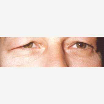 45-54 year old woman treated with Eye Bags Treatment before 3544924