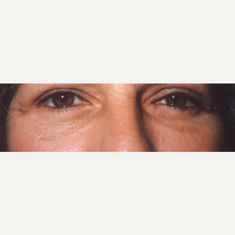 45-54 year old woman treated with Eye Bags Treatment after 3544924