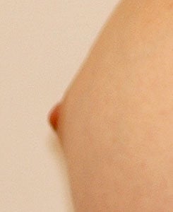 Before and After Nipple Reduction (Length) after 65315