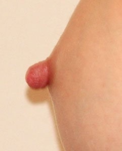 Before and After Nipple Reduction (Length) before 65315