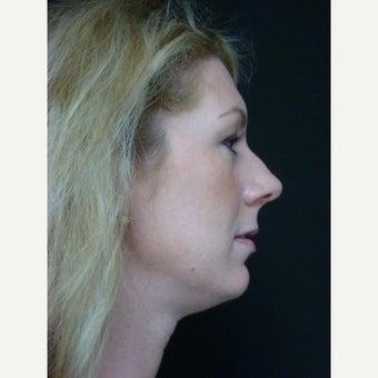 25-34 year old female, 18 Months Post Full Face Ultherapy Procedure before 1547693