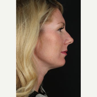 25-34 year old female, 18 Months Post Full Face Ultherapy Procedure after 1547693