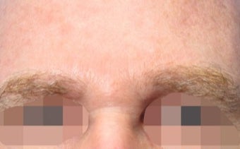 45-54 year old man treated with Wrinkle Treatment after 2306601