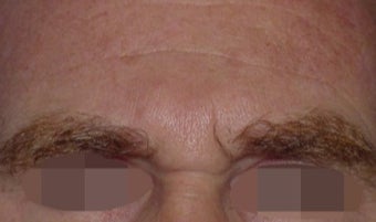 45-54 year old man treated with Wrinkle Treatment before 2306601